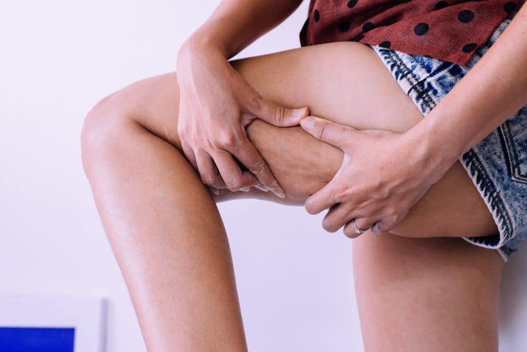 come togliere la cellulite,rimedi per la cellulite,dieta per cellulite,come eliminare la cellulite,come combattere la cellulite