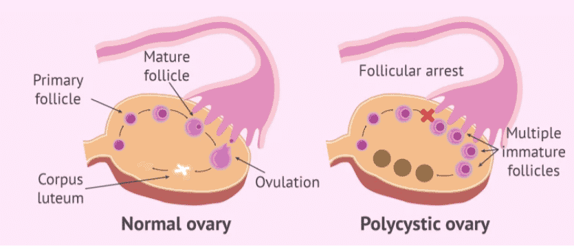 ovaio policistico rimedi naturali